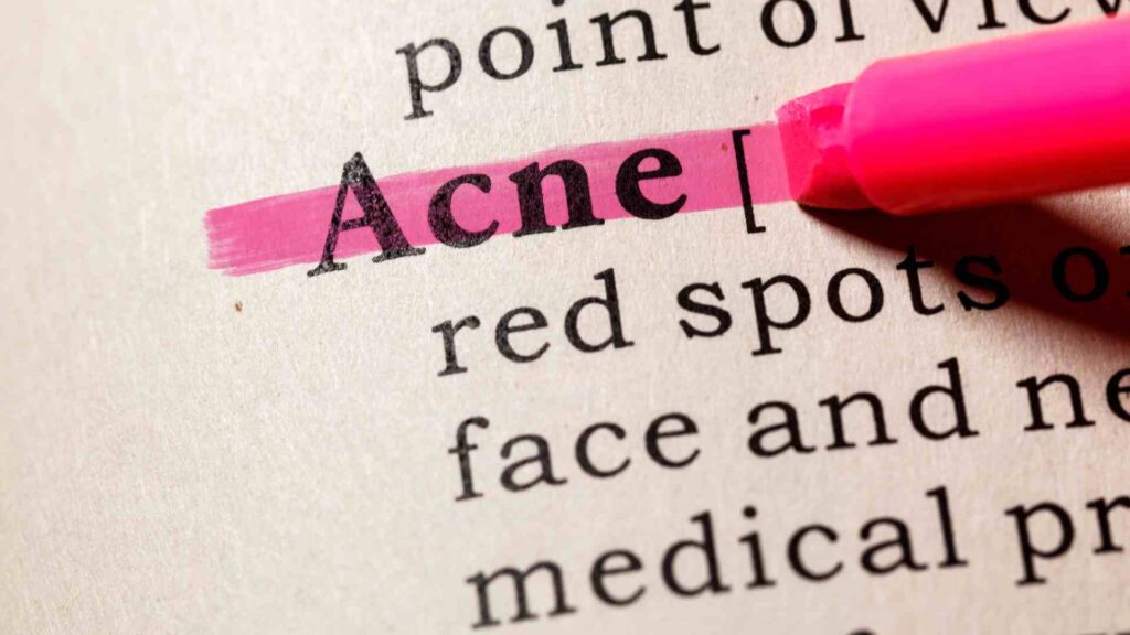 ordet acne overstreget med en lyseroed sprittusch