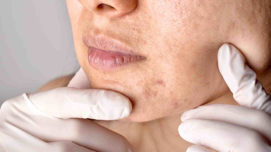 closeup af kvindes underansigt med akne ar