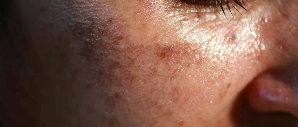closeup af et ansigt med pigmentpletter